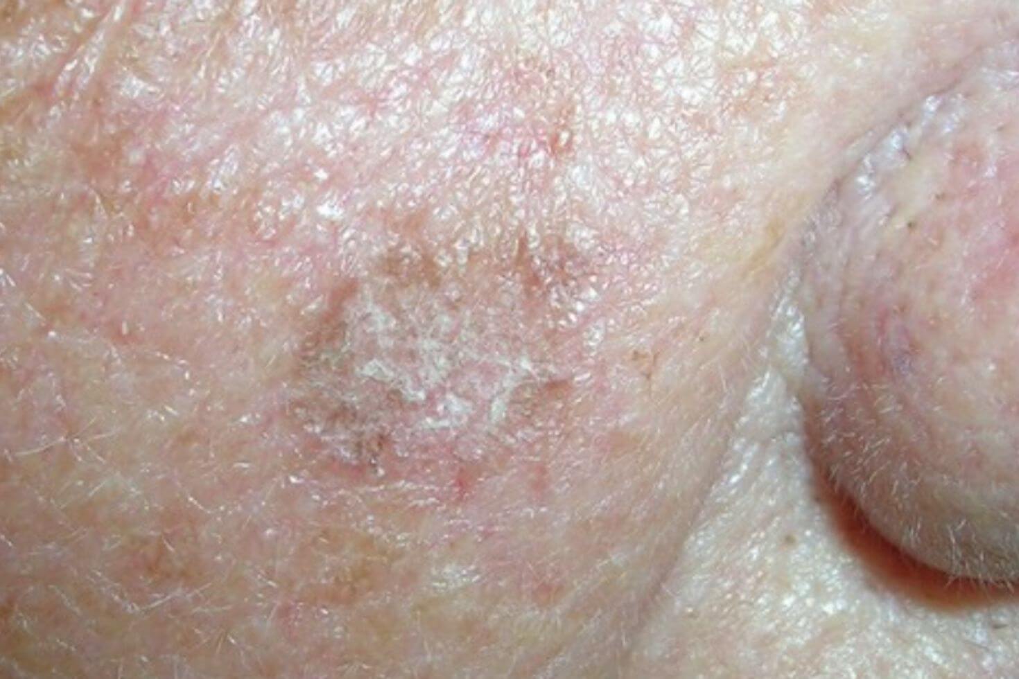 Carcinom cutanat spinocelular 3 Carcinom cutanat spinocelular 3