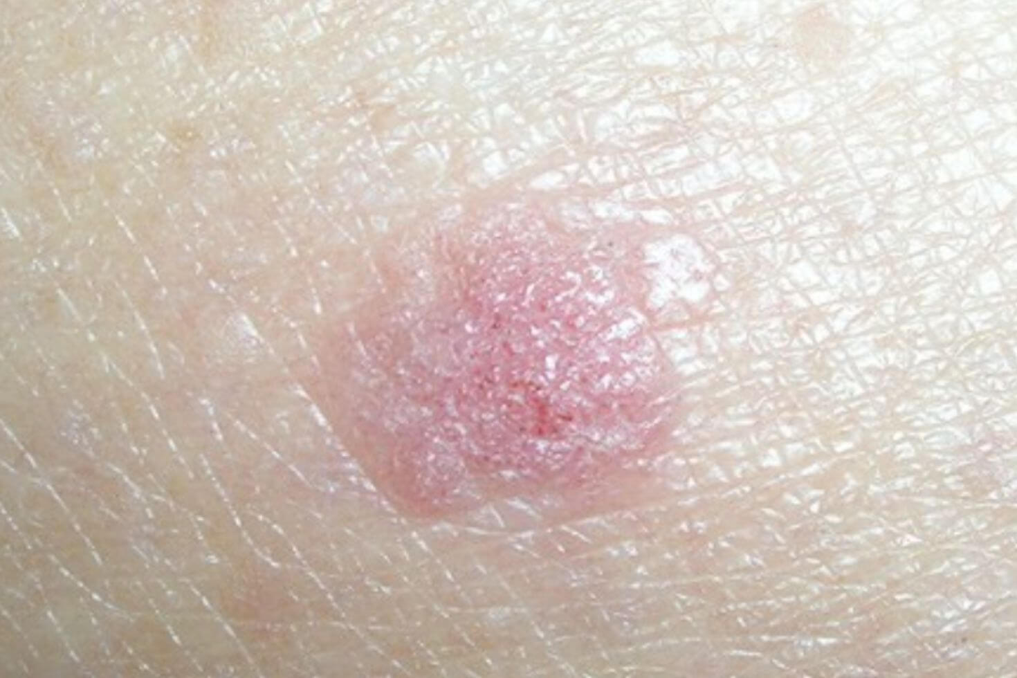 Carcinom cutanat spinocelular 4 Carcinom cutanat spinocelular 4
