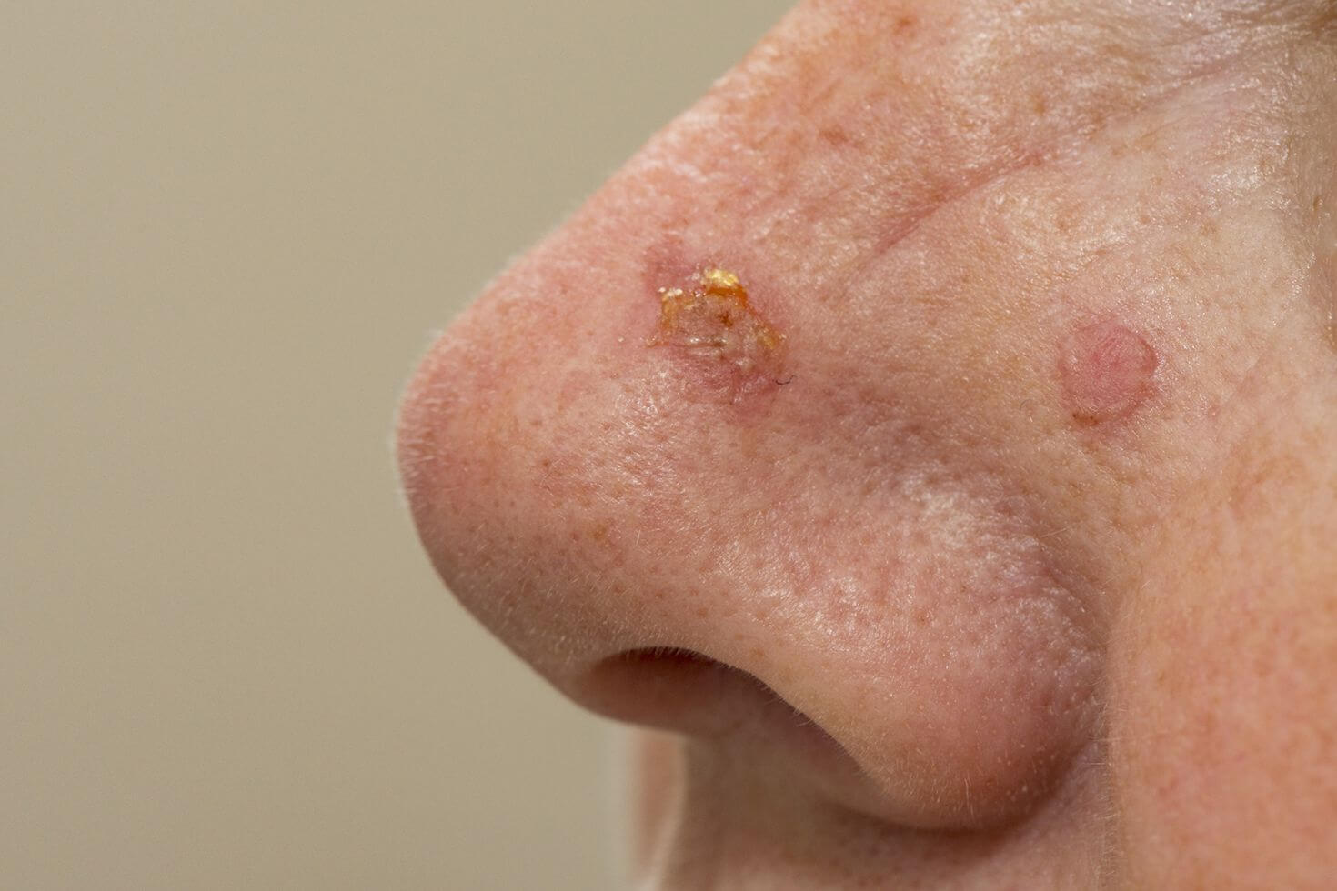 Carcinom cutanat spinocelular 5 Carcinom cutanat spinocelular 5