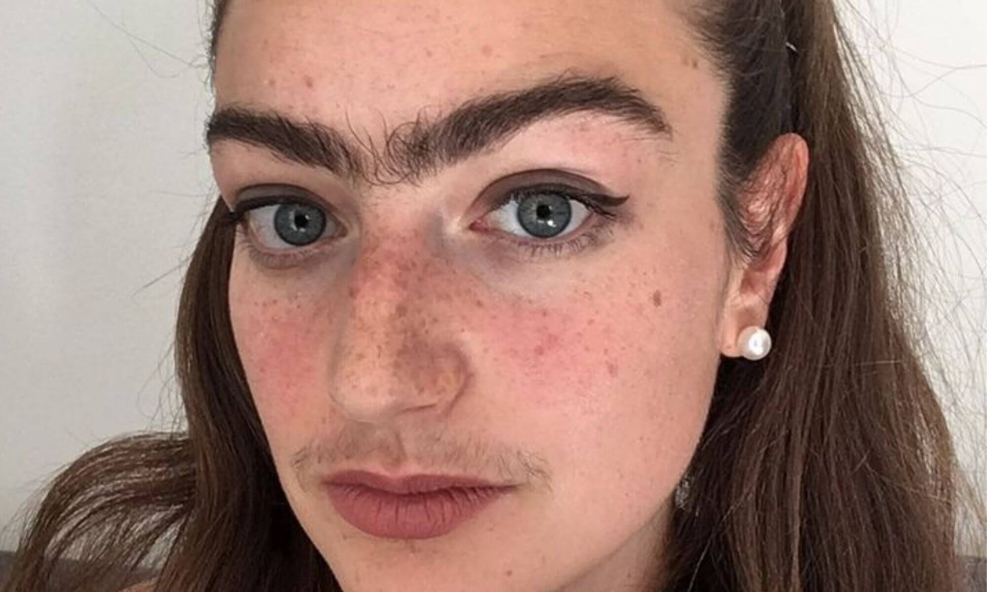 Ce tipuri de tratament pentru pilozitate excesiva la femei prescriu doctorii