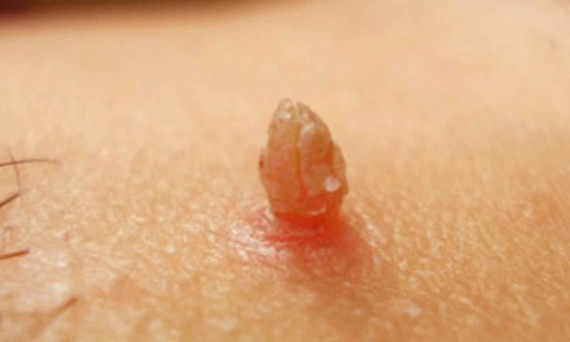 Cum arata verucile filiforme Cum arata verucile filiforme