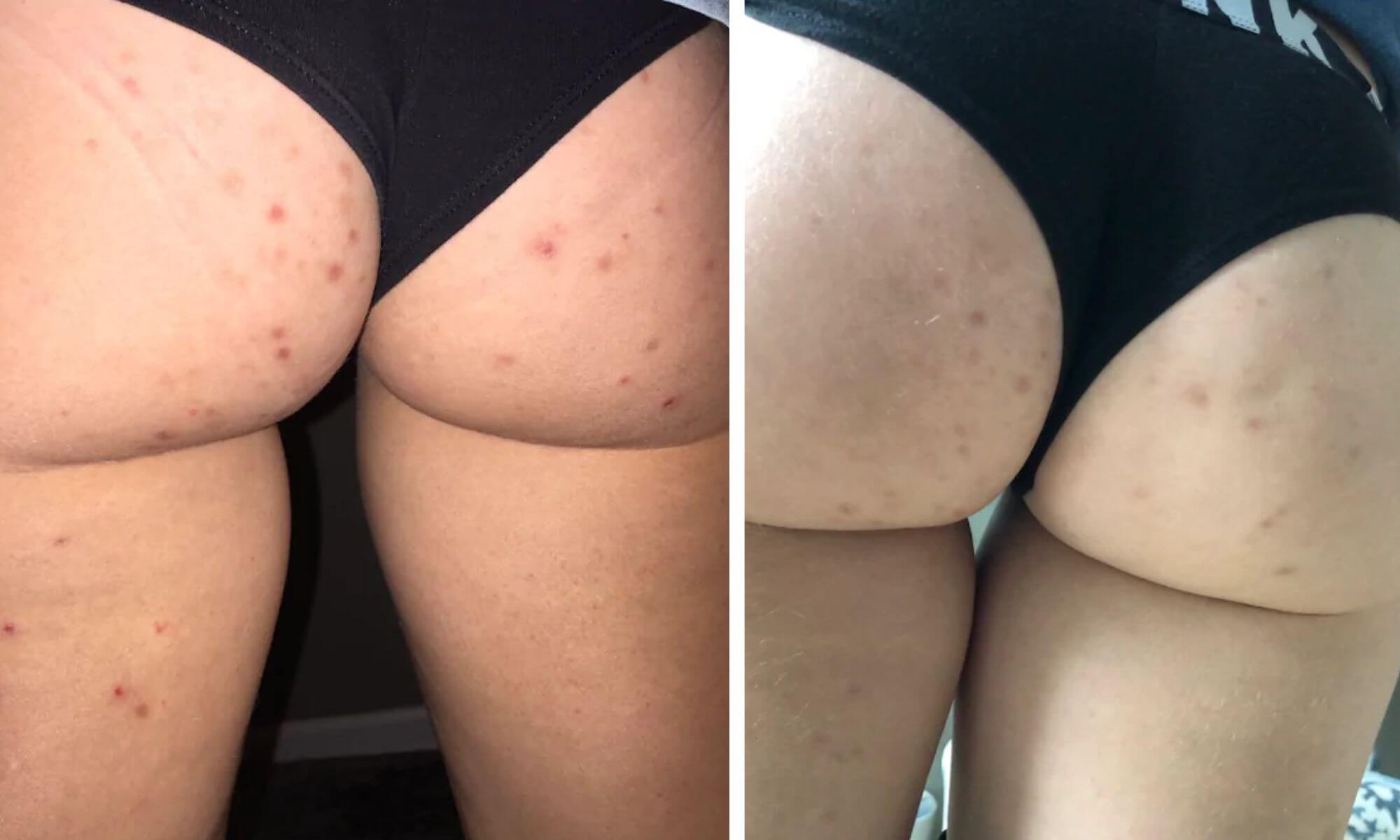 De ce apar cosuri pe fund si cum poti scapa de ele