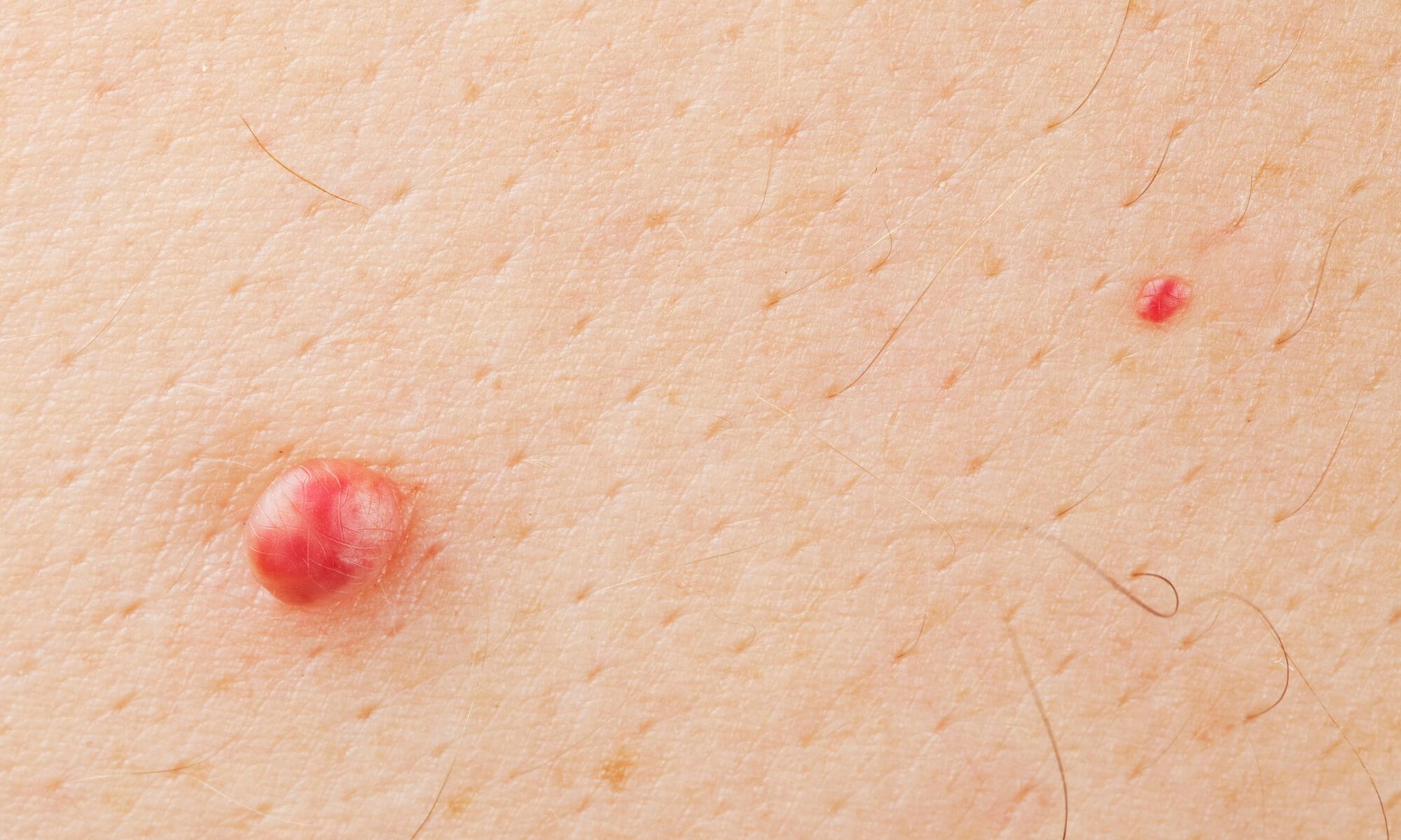 Factori de risc veruci filiforme Factori de risc veruci filiforme