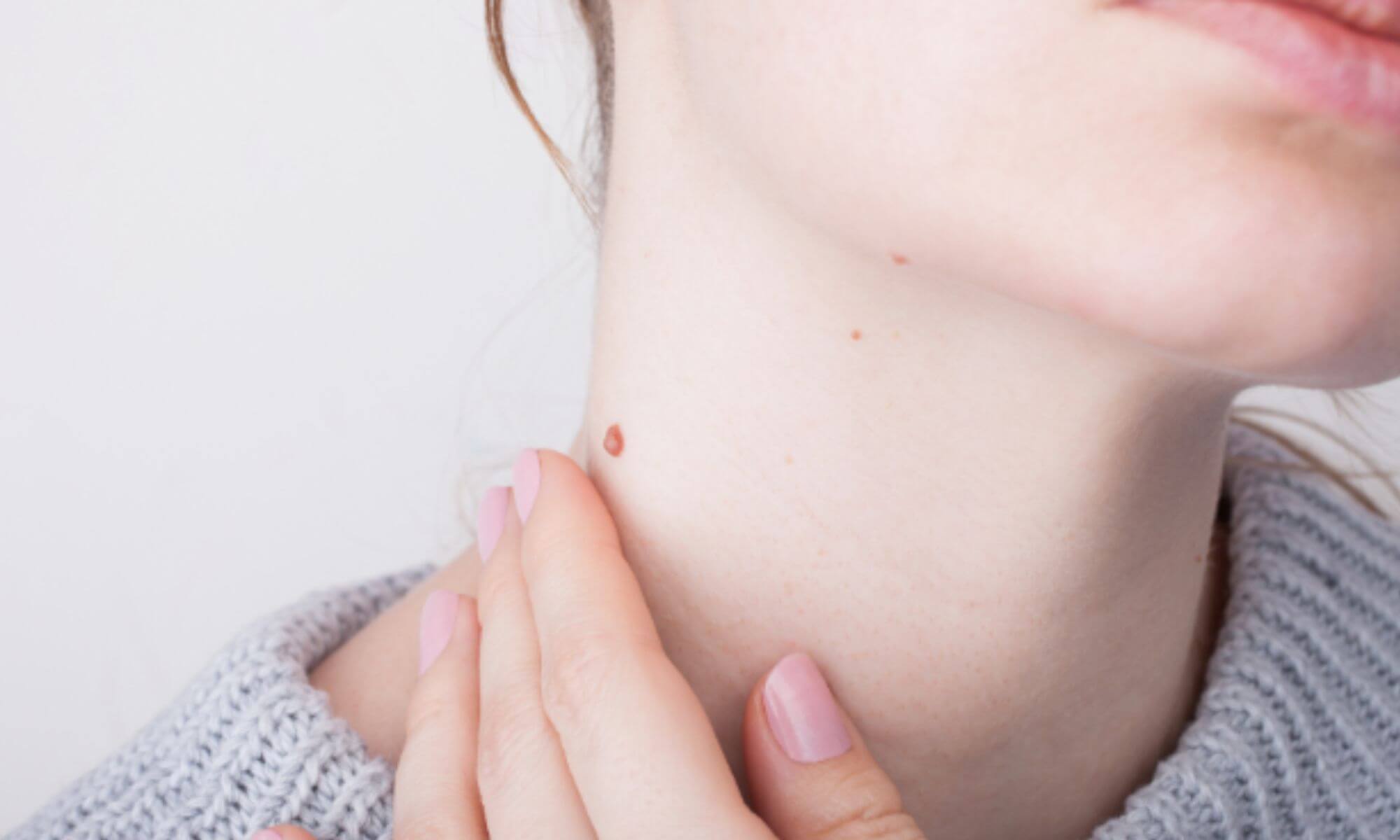 Negi pe gat. 9 variante prin care poti scapa de ei