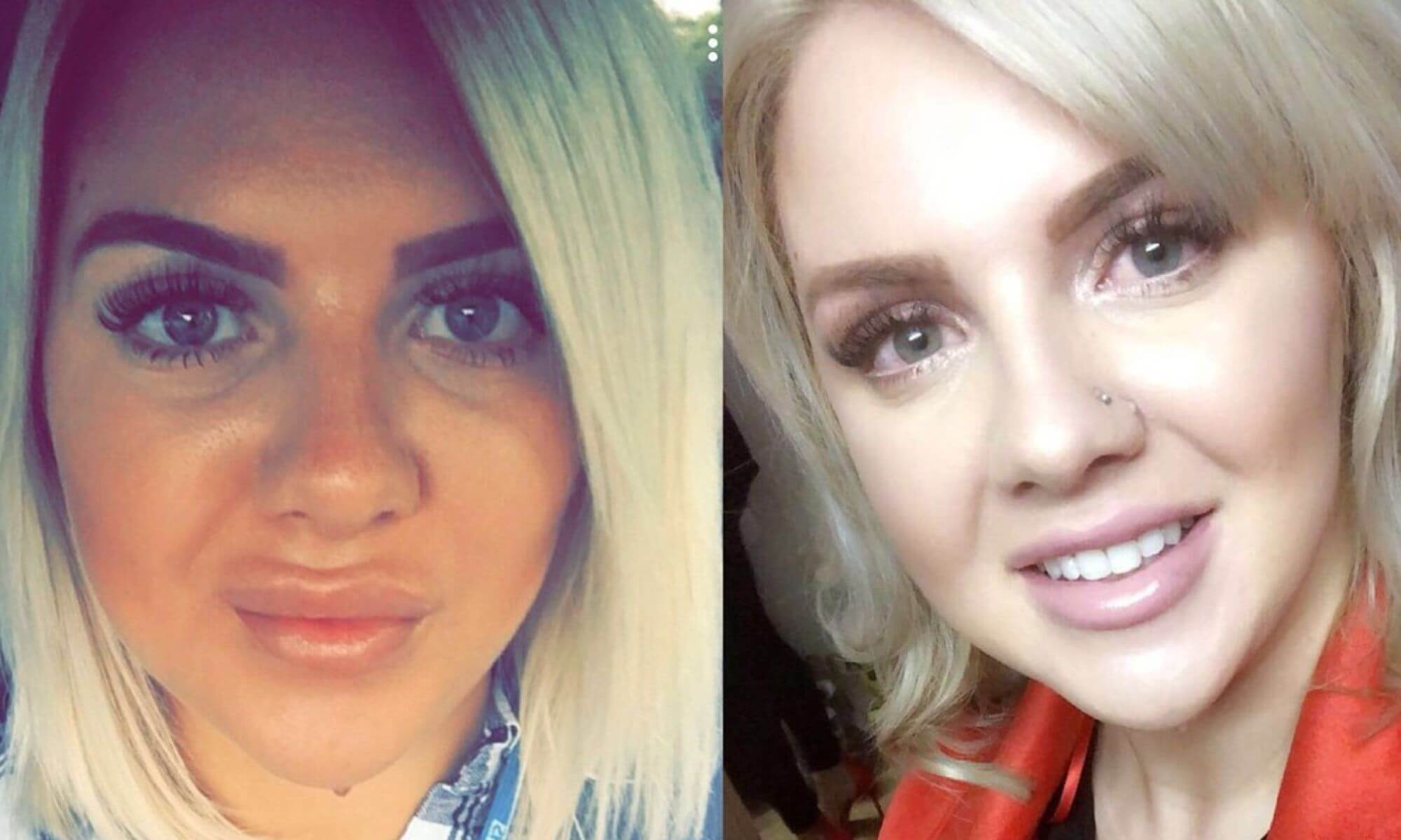 Vrei o dizolvare de acid hialuronic Iata ce sa iei in calcul 2