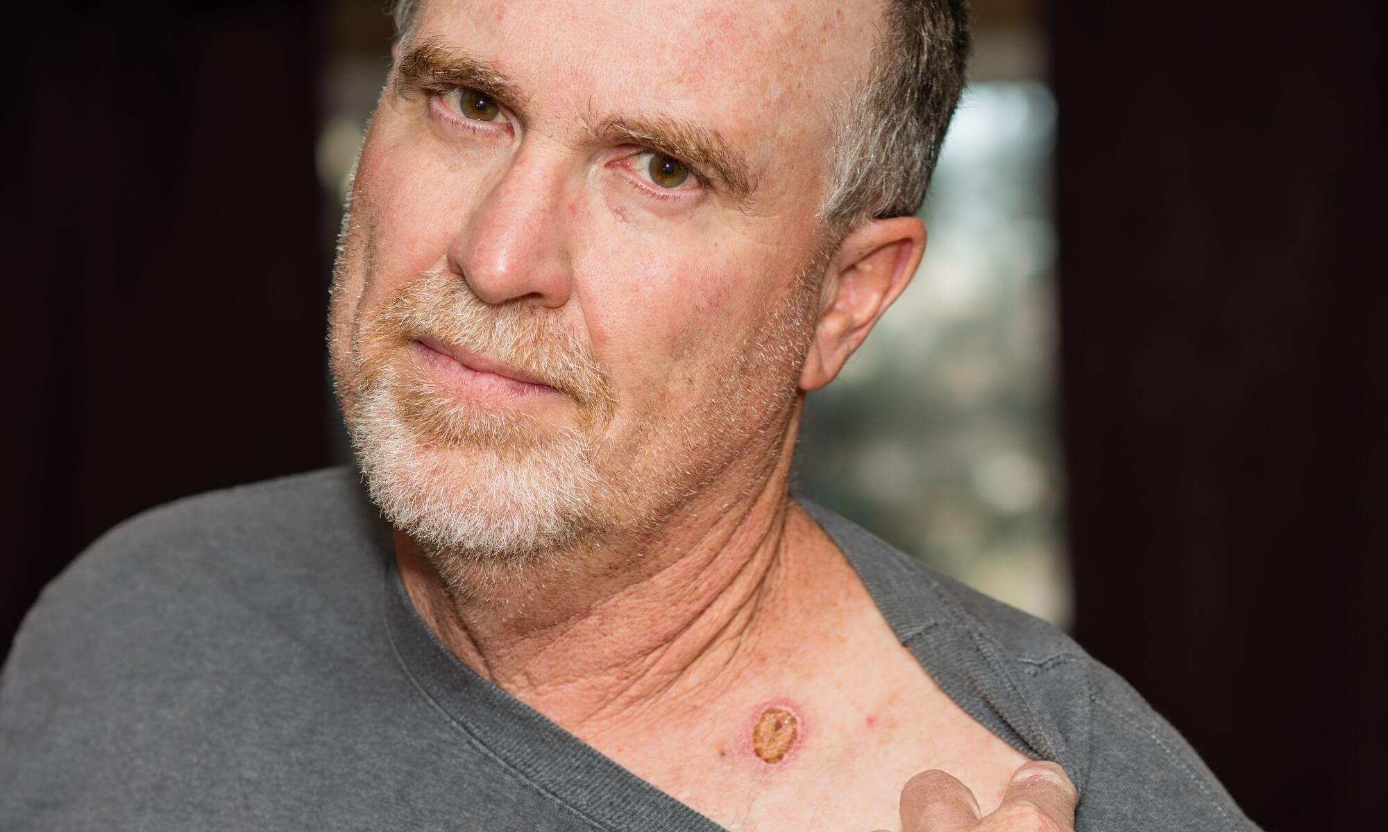 Carcinom spinocelular cum arata si cum il poti preveni