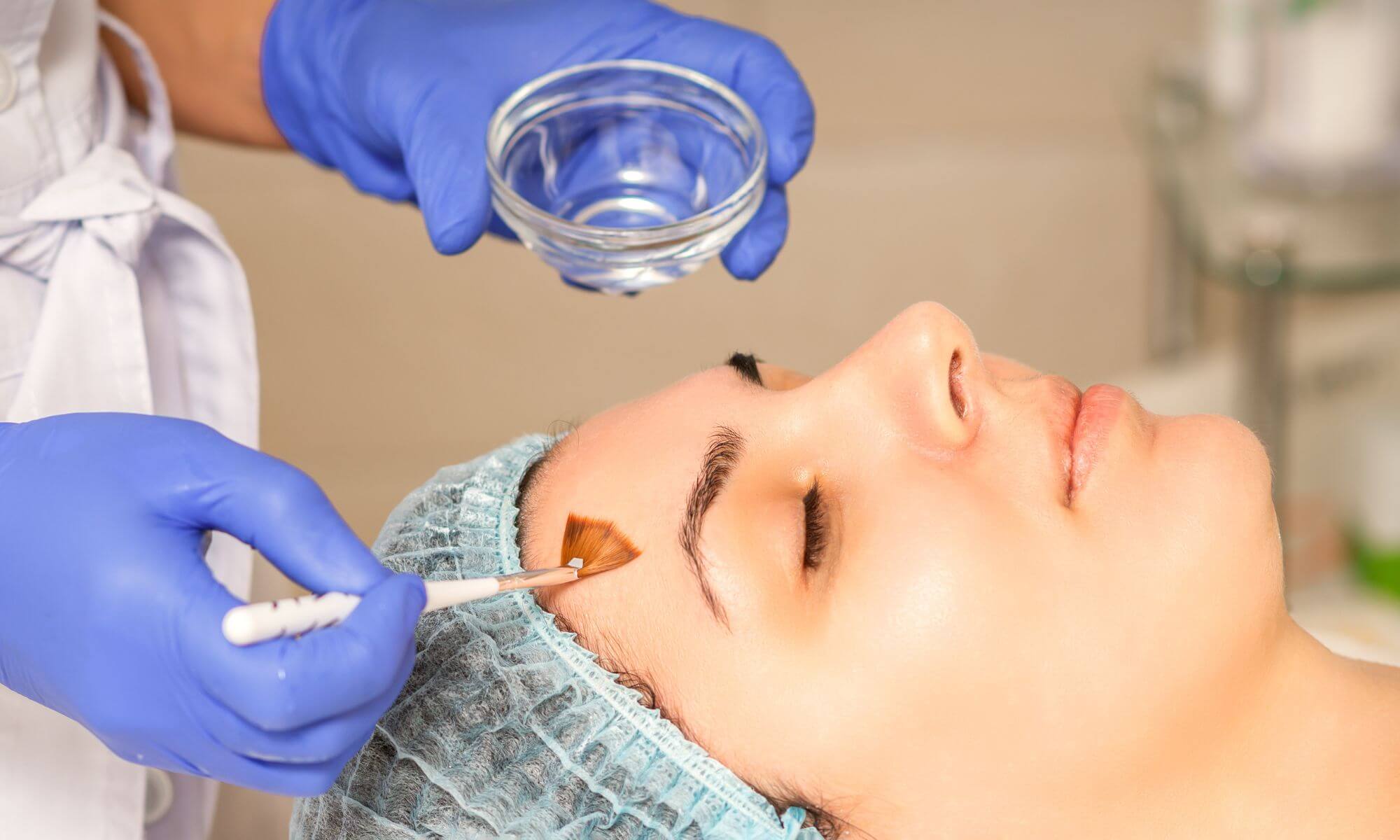 Peeling chimic facial ce risti si ce castigi