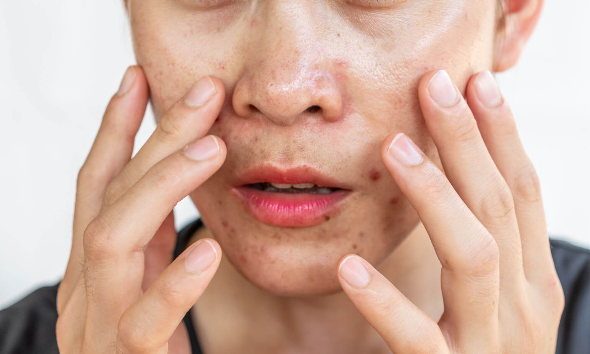 Vindecarea cosurilor stoarse pas cu pas