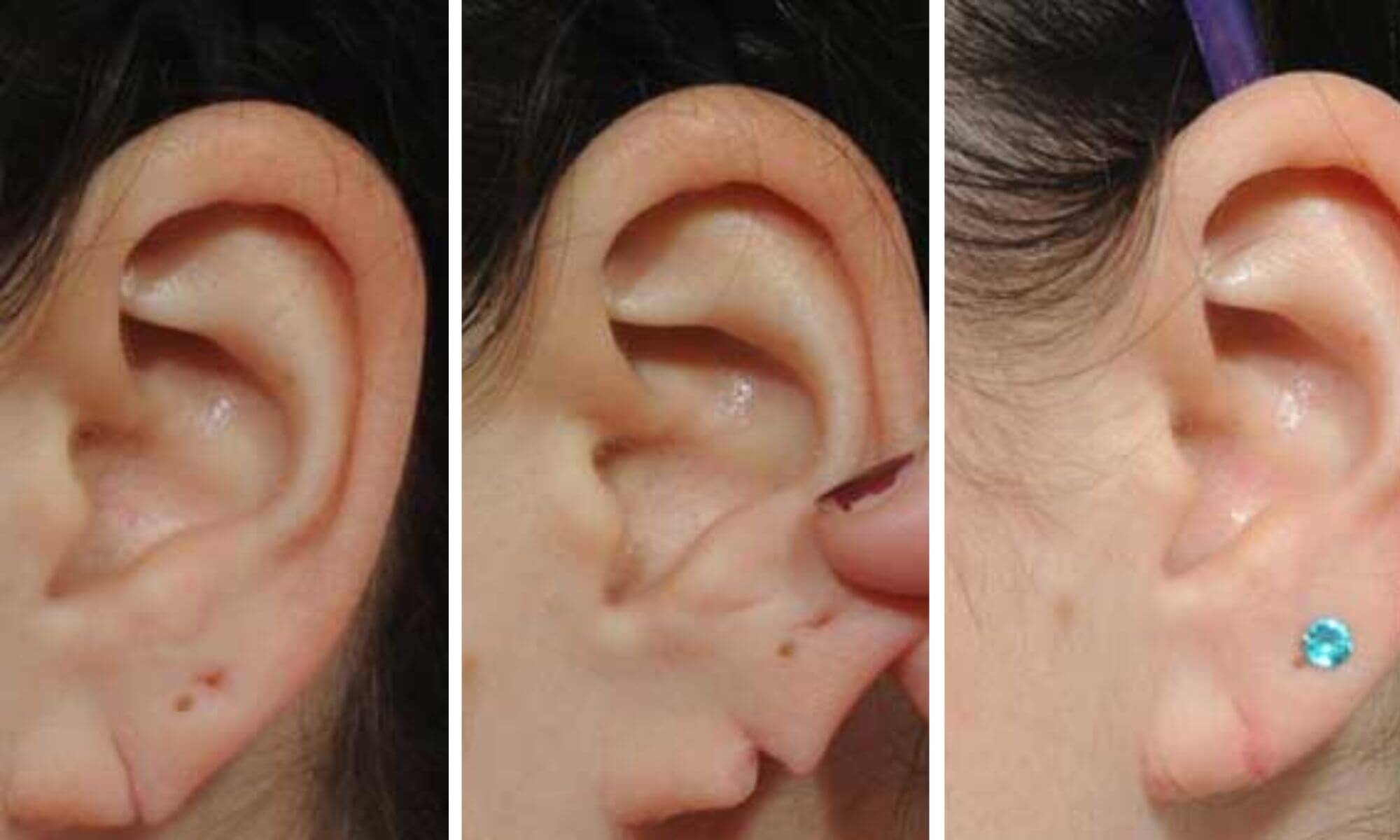 Am lobul urechii rupt Cum se poate repara