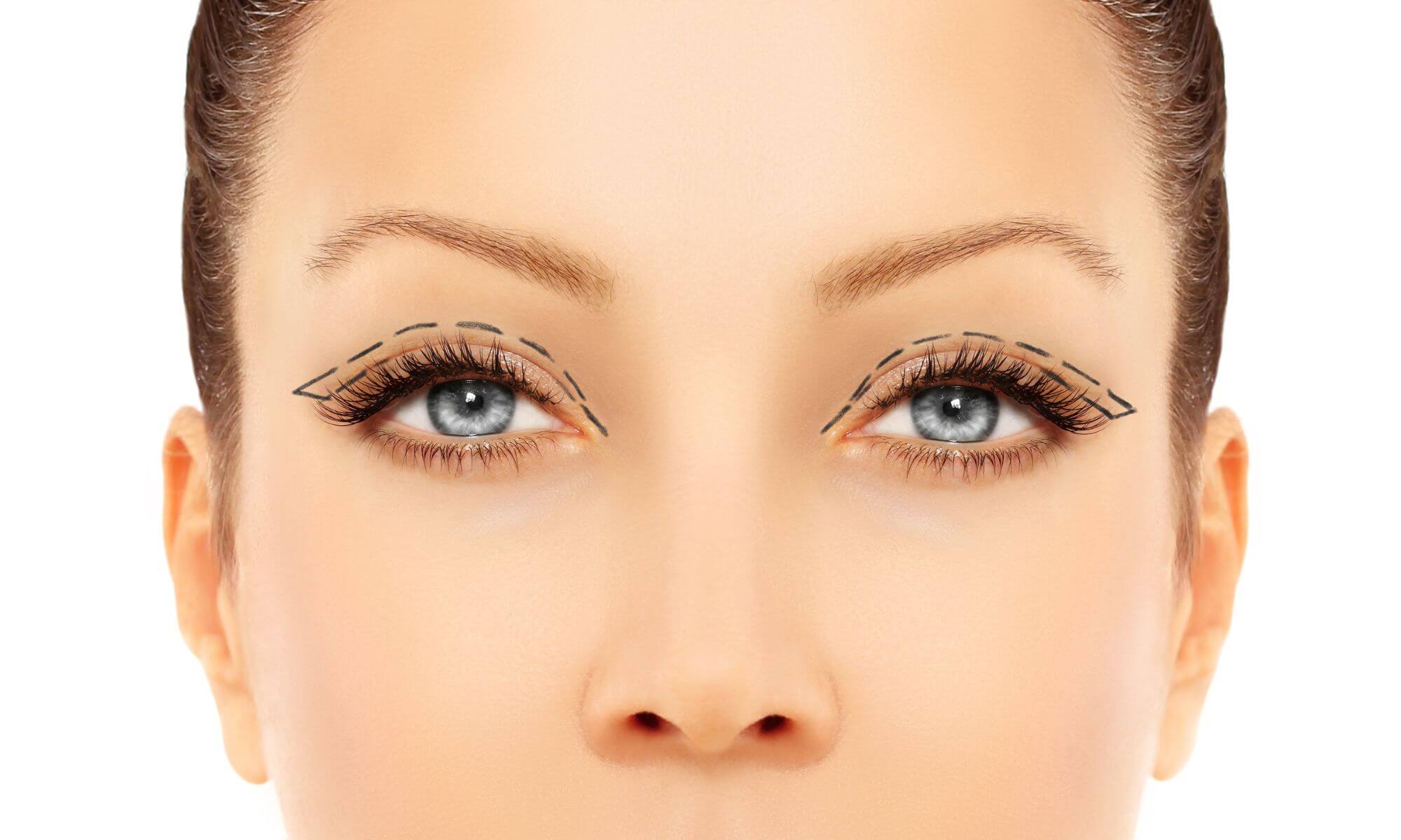 Ridicare pleoape crema laser Botox sau operatie chirurgicala