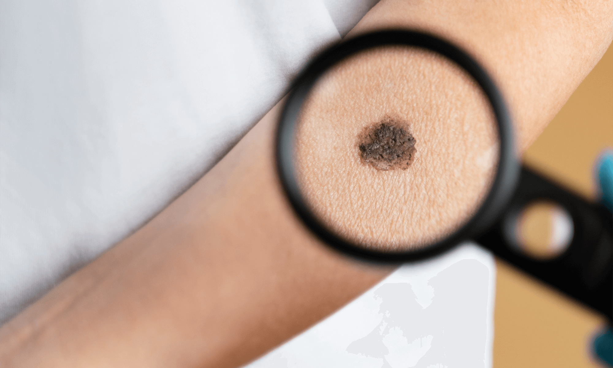 Nev pigmentar gigant– problema estetica sau chirurgicala