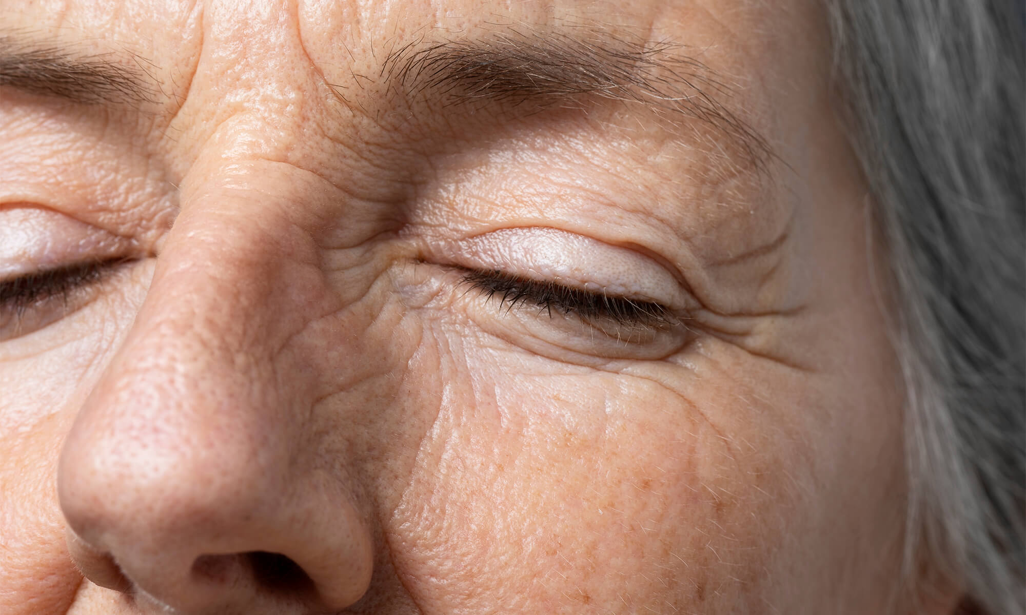 Xantelasme ce sunt si cand devin periculoase