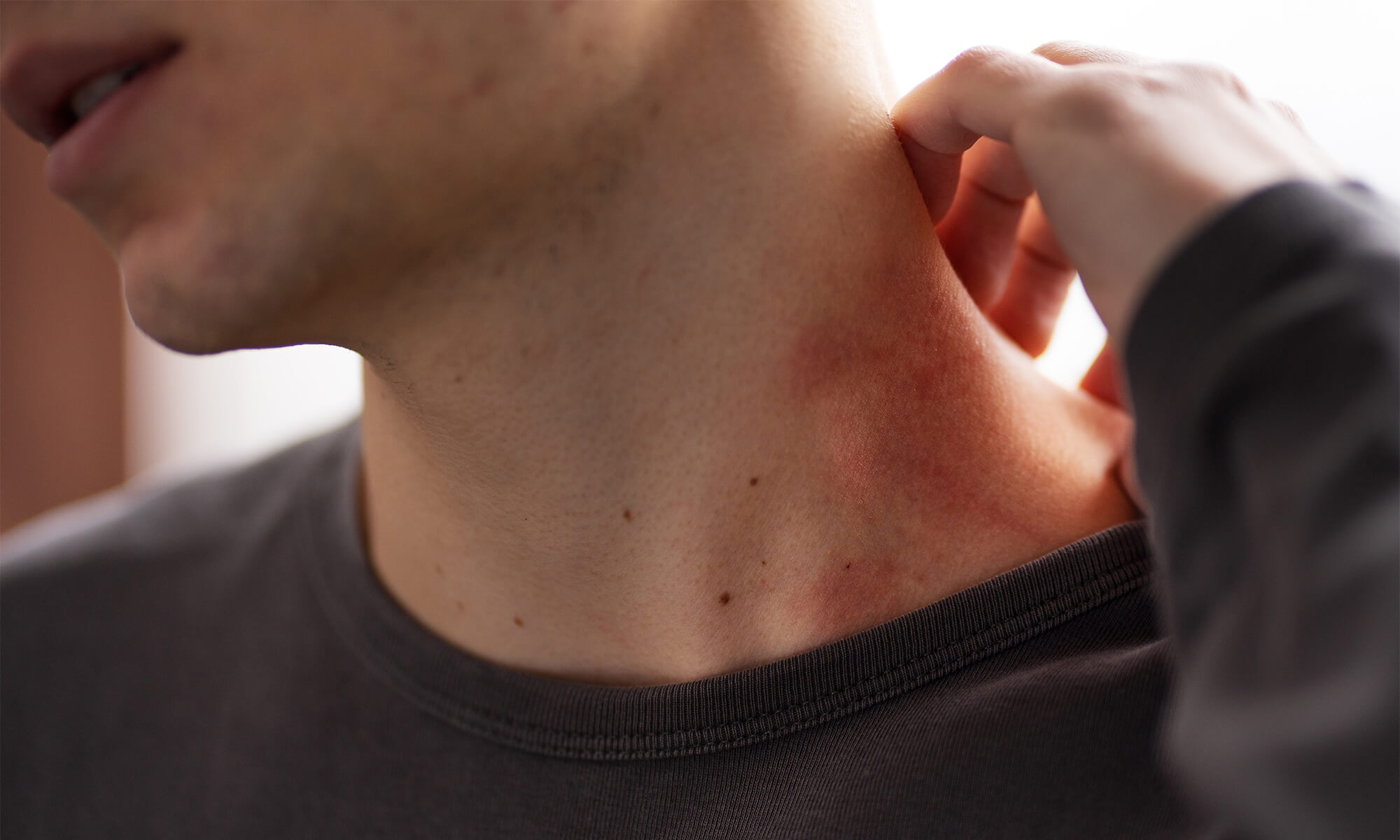 Tratamente recomandate de specialisti pentru piele atopica