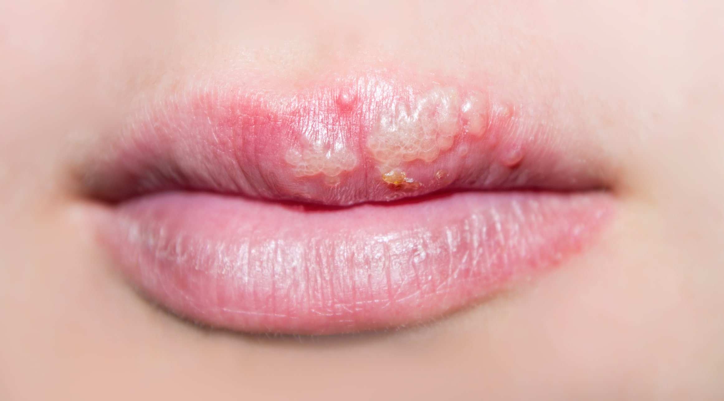 Herpes oral pe buze – simptome și tratament dermatologic