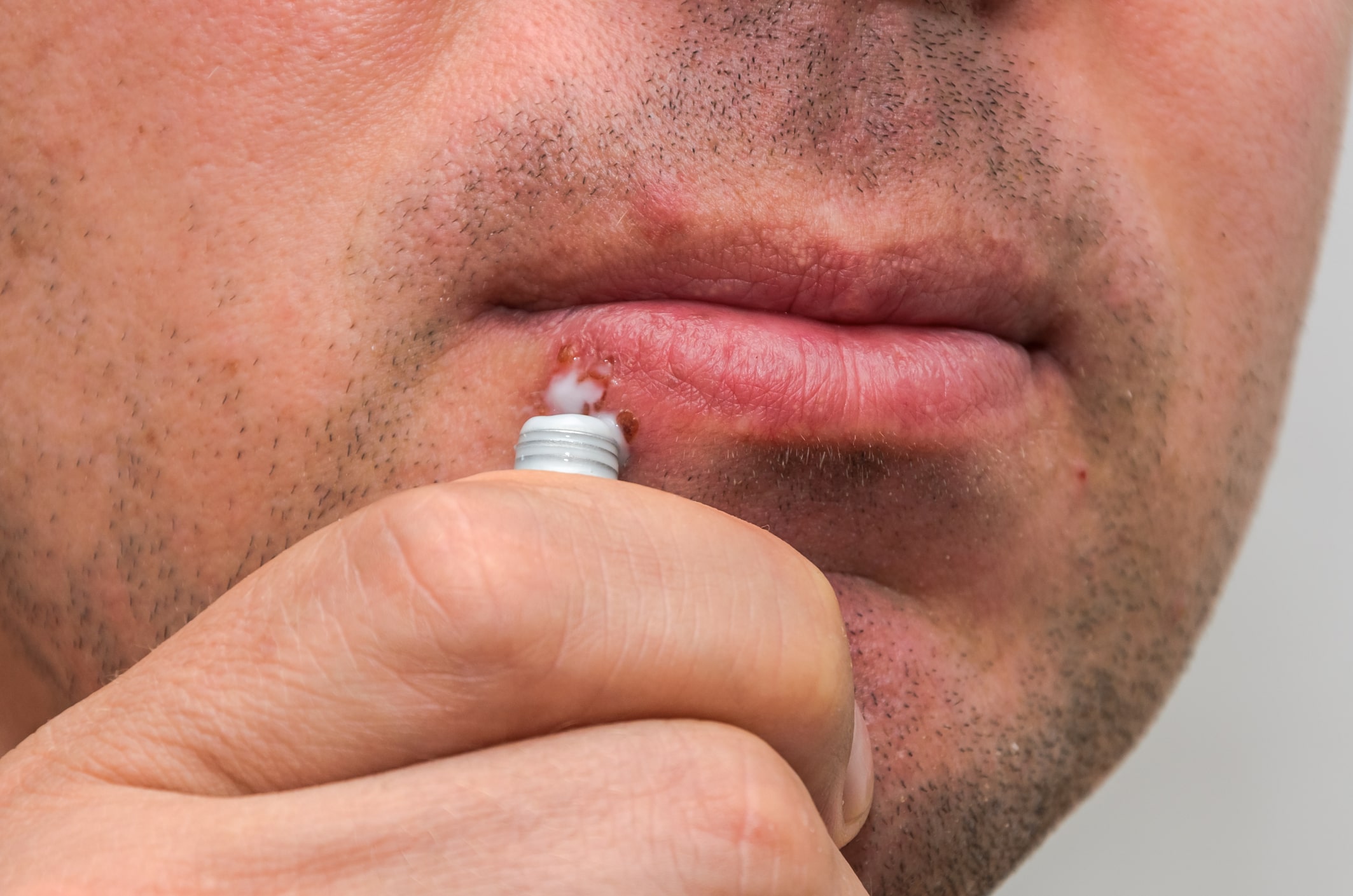 Unguent pentru herpes labial – soluție rapidă de vindecare