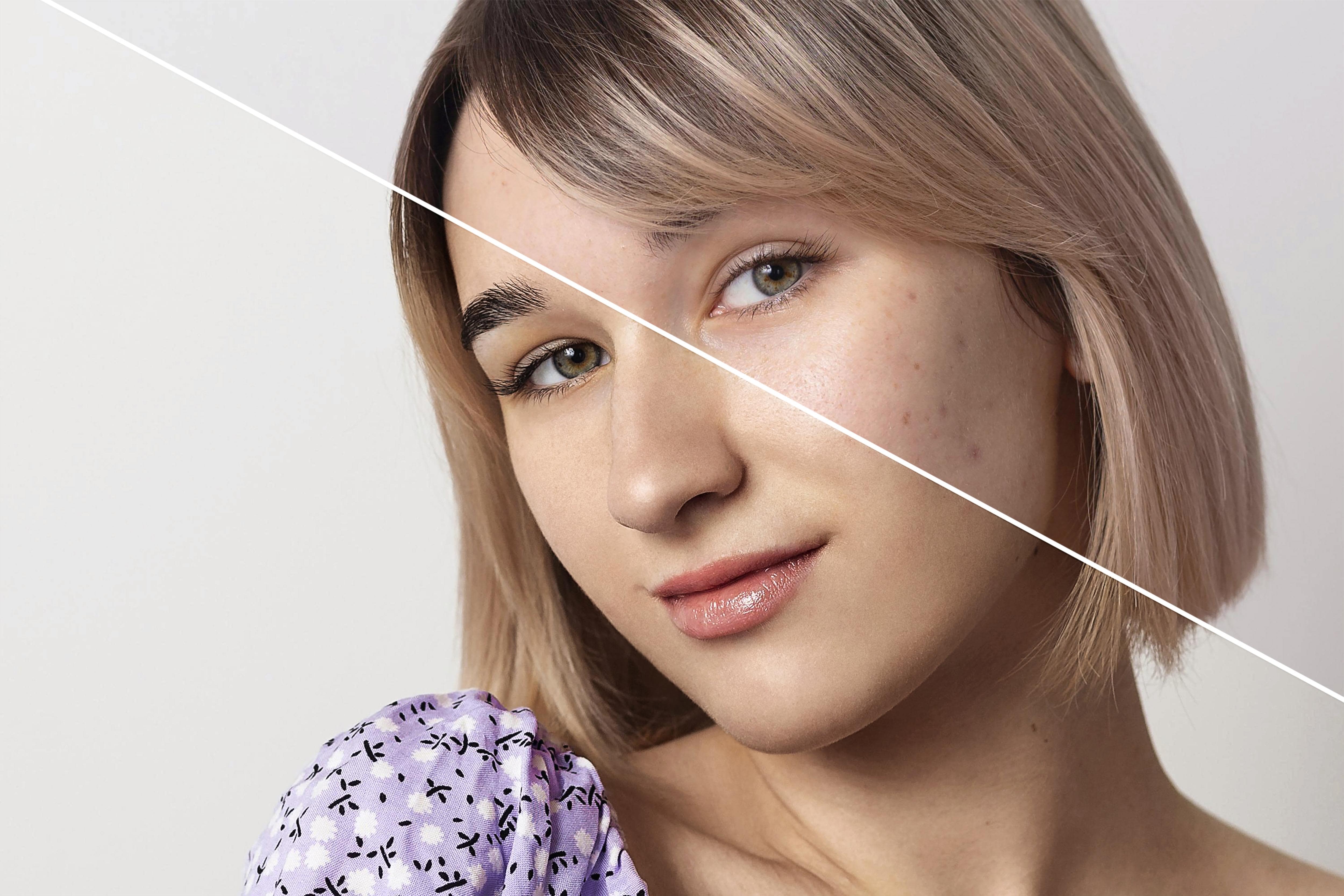 ingrijire-piele-dupa-mezoterapie-faciala Îngrijirea pielii după tratamentul de mezoterapie facială