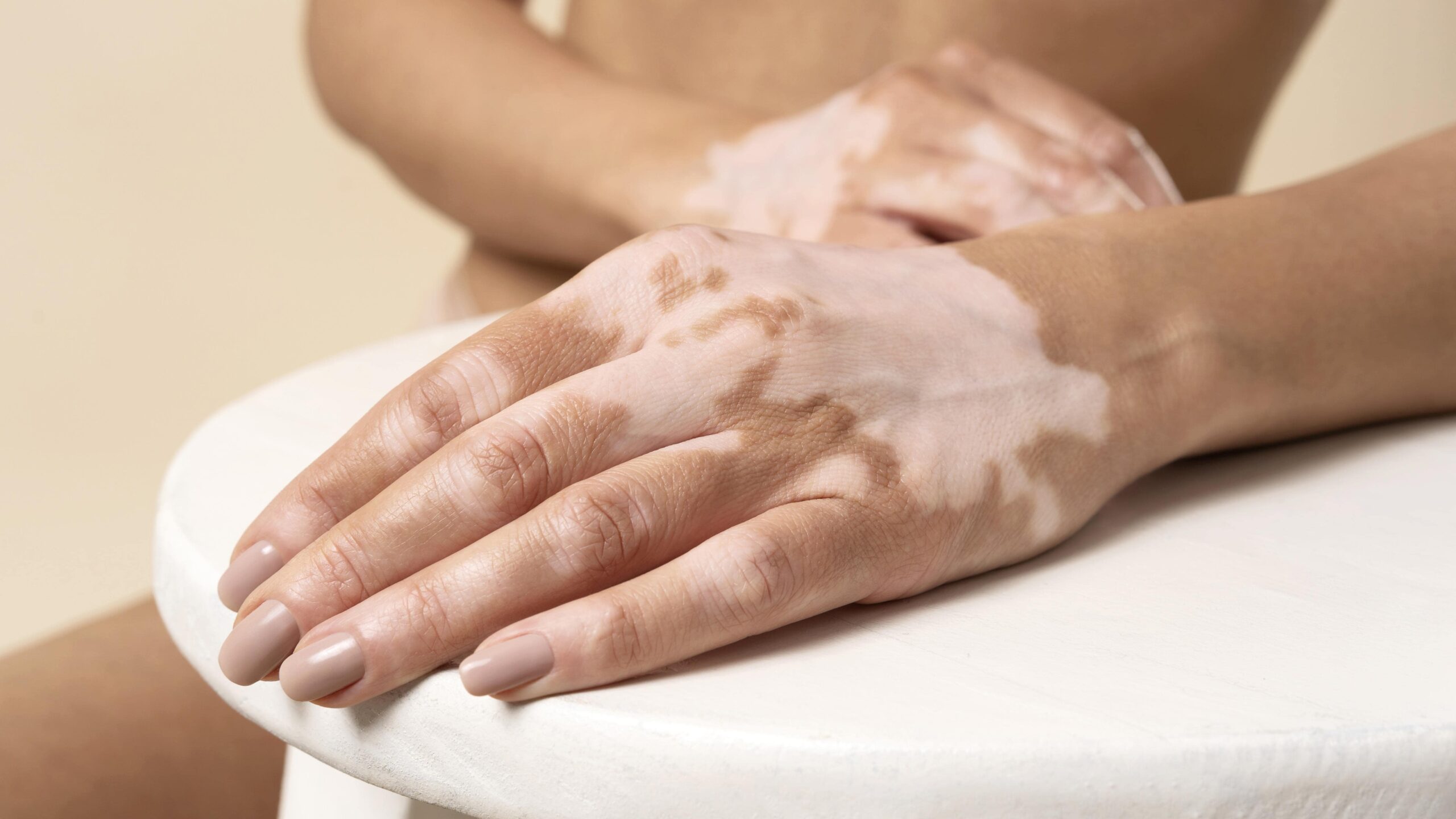 Tratament vitiligo realizat de dermatolog în Craiova