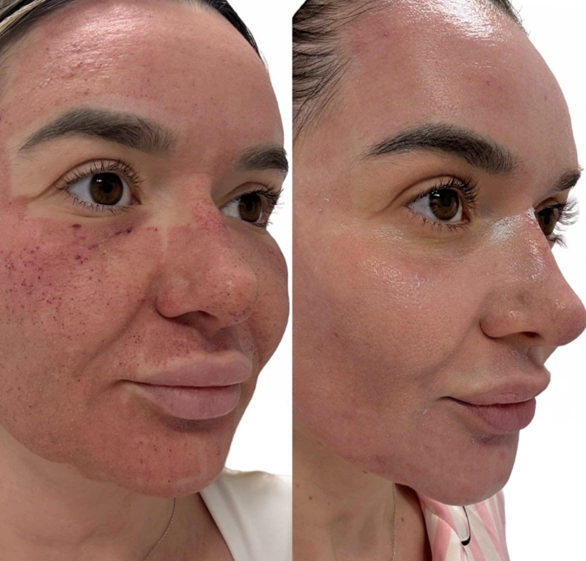 Aspectul pielii imediat după tratament laser CO2 la Clinica Medlink