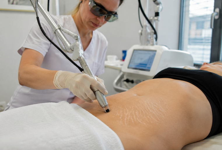 scapa-de-vergeturi-cu-laser-co2-abdomen-clinica-medlink-craiov