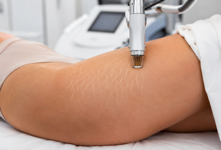 Scapă de vergeturi cu Laser CO2 tratament pentru vergeturi pe picioare la Clinica Medlink Craiova