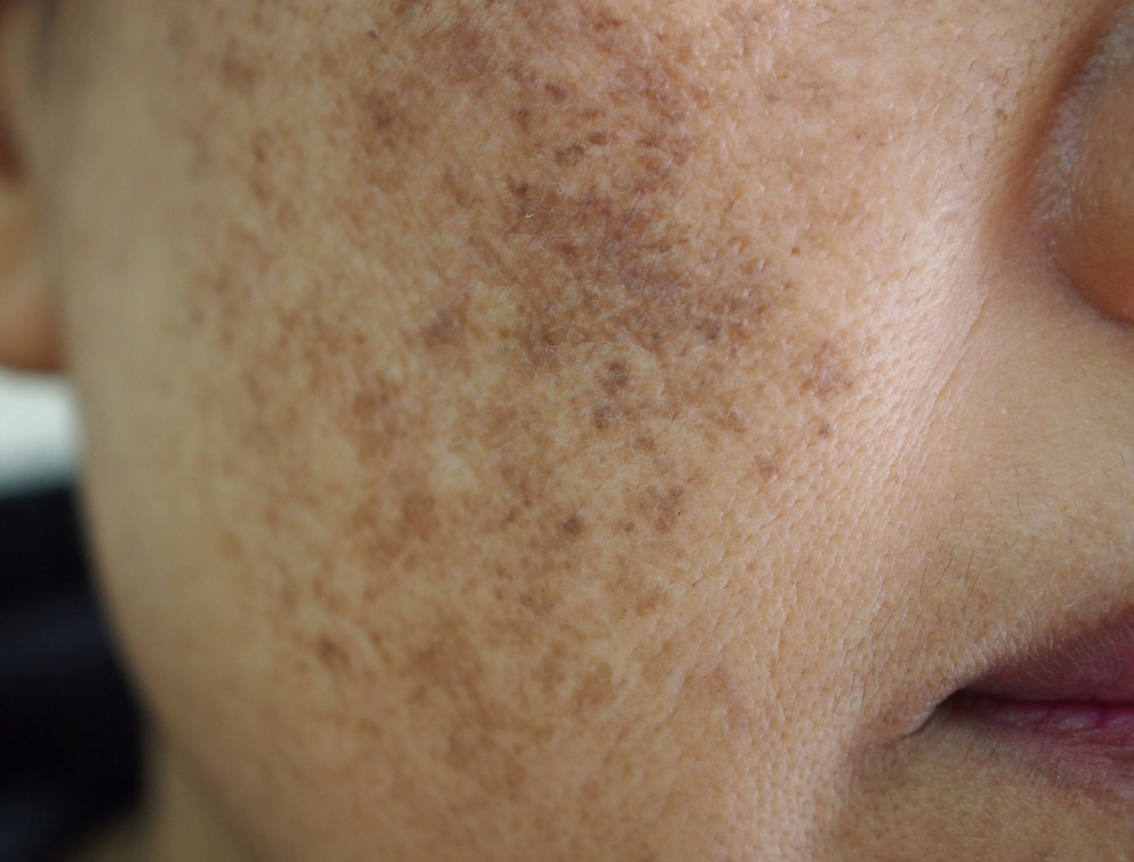 melasma-pe-fata-obraz-clinica-medlink-craiova Pacientă care observă în oglindă melasma și modificările de pigment de pe obraz la Clinica Medlink Craiova