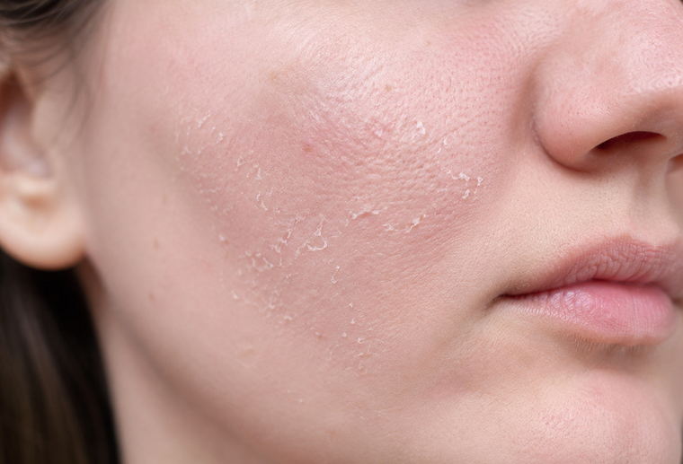 piele-care-se-descuameaza-cauze-tratament-medlink-craiova Piele care se descuamează cauze și tratament dermatologic Clinica Medlink Craiova