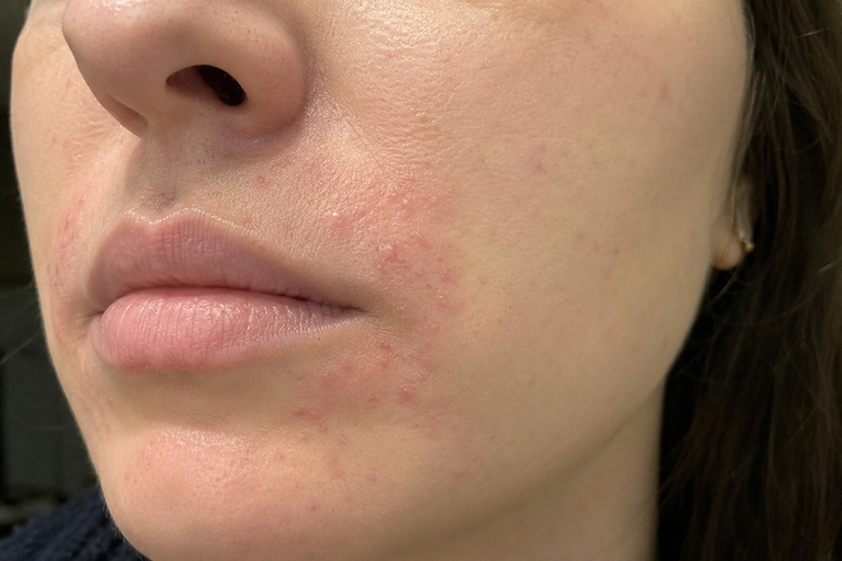 dermatita-periorala-bubite-in-jurul-gurii