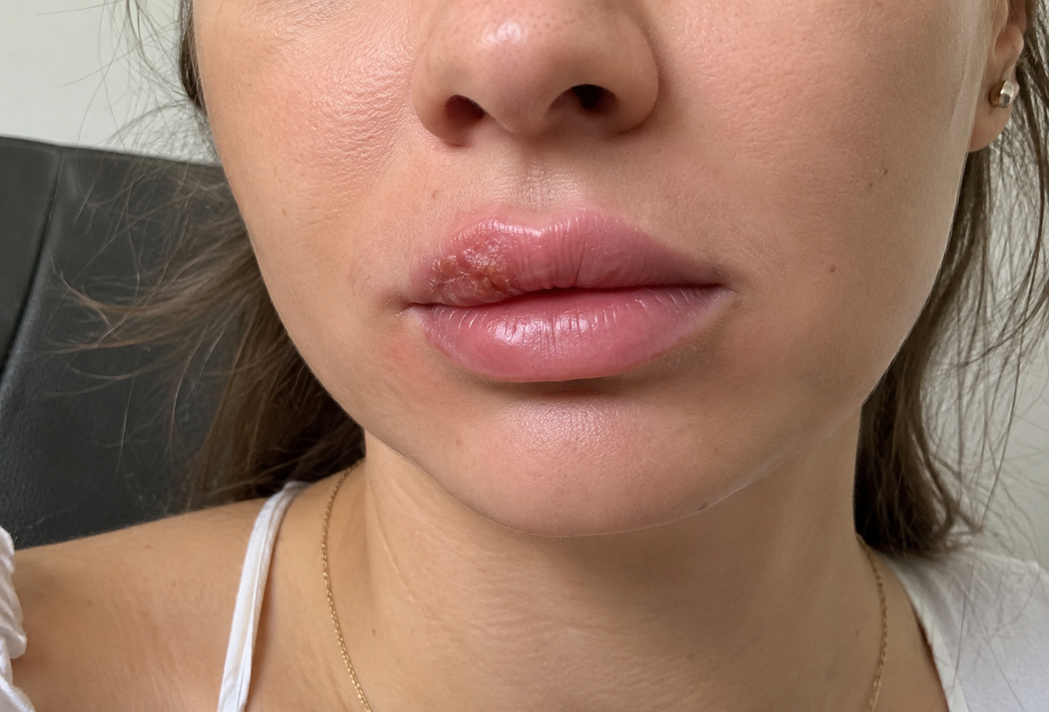 Herpes după injectarea buzelor la o pacientă evaluată la Clinica Medlink Craiova