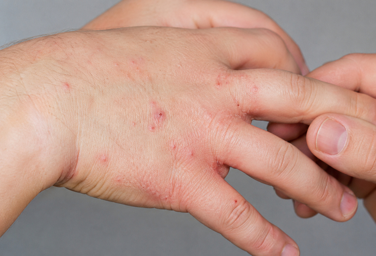 scabia-mancarime-nocturna-simptome Mâncărime nocturnă provocată de scabie la nivelul mâinilor