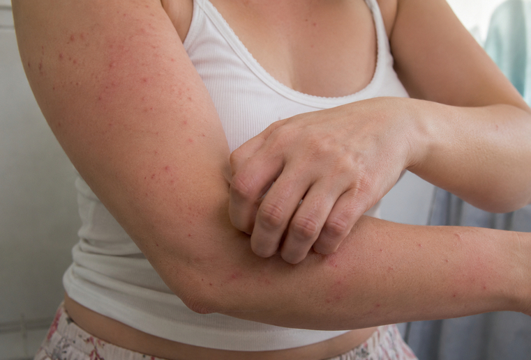 Scabia – simptome specifice și leziuni apărute pe piele
