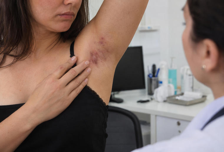 consult-dermatologic-hidradenita-craiova Consult dermatologic pentru hidradenită supurativă în Craiova