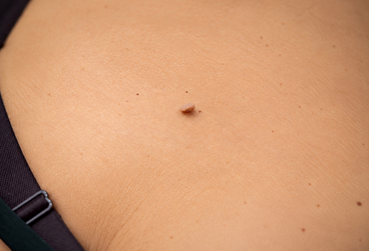 papiloame-evaluare-dermatologica Papiloame evaluate înainte de îndepărtare